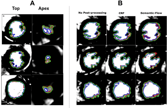Figure 2 for Automated segmentation on the entire cardiac cycle using a deep learning work-flow