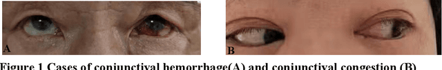 Figure 2 for The Report on China-Spain Joint Clinical Testing for Rapid COVID-19 Risk Screening by Eye-region Manifestations