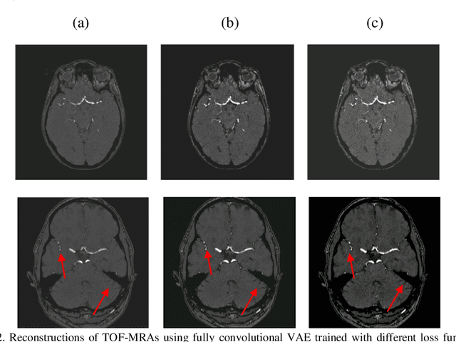 Figure 3 for Variational Autoencoders with a Structural Similarity Loss in Time of Flight MRAs