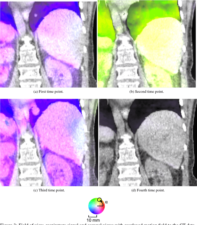 Figure 3 for Interpatient Respiratory Motion Model Transfer for Virtual Reality Simulations of Liver Punctures