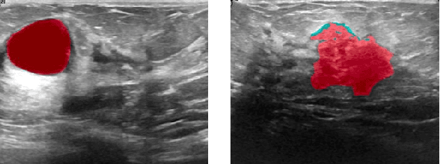 Figure 2 for Semantic Segmentation and Object Detection Towards Instance Segmentation: Breast Tumor Identification