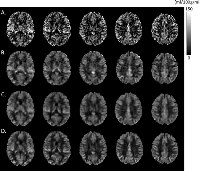 Figure 3 for A Learning-from-noise Dilated Wide Activation Network for denoising Arterial Spin Labeling Perfusion Images