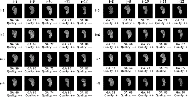 Figure 4 for Multi-Atlas Segmentation and Spatial Alignment of the Human Embryo in First Trimester 3D Ultrasound