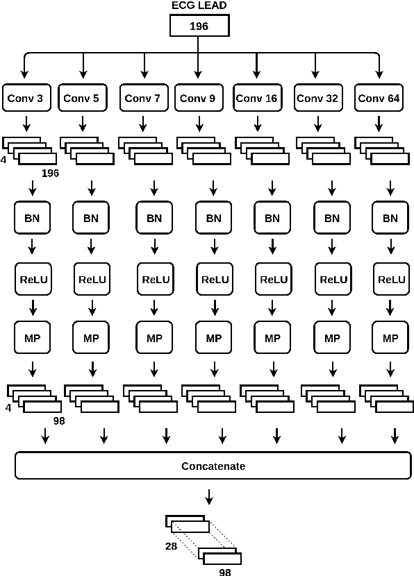 Figure 2 for Detection of Inferior Myocardial Infarction using Shallow Convolutional Neural Networks