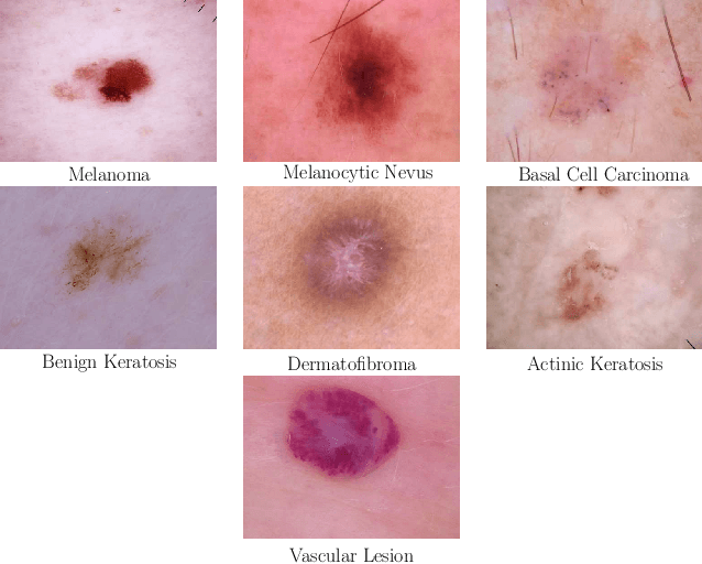 Figure 1 for Skin Lesion Classification Using CNNs with Patch-Based Attention and Diagnosis-Guided Loss Weighting