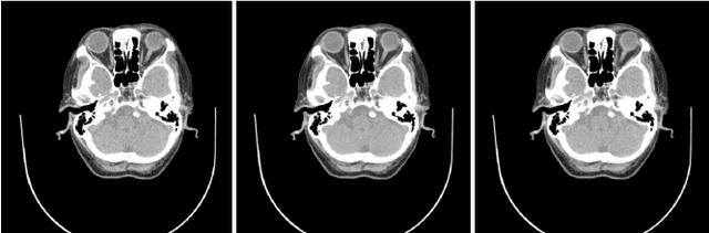 Figure 3 for Fast LLMMSE filter for low-dose CT imaging