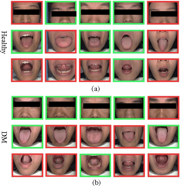 Figure 1 for Multi-modal Fusion for Diabetes Mellitus and Impaired Glucose Regulation Detection