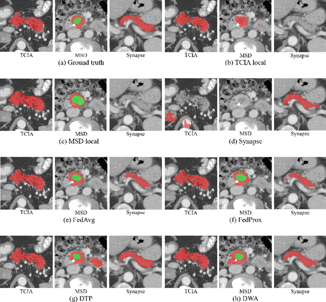 Figure 4 for Multi-task Federated Learning for Heterogeneous Pancreas Segmentation