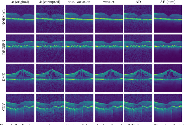 Figure 2 for Semantic denoising autoencoders for retinal optical coherence tomography