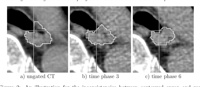 Figure 4 for Measuring breathing induced oesophageal motion and its dosimetric impact