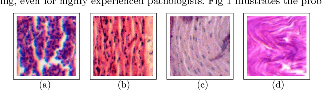Figure 1 for CapsDeMM: Capsule network for Detection of Munro's Microabscess in skin biopsy images