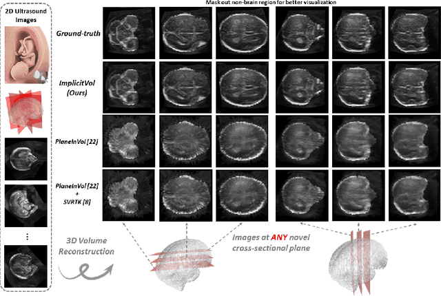 Figure 1 for ImplicitVol: Sensorless 3D Ultrasound Reconstruction with Deep Implicit Representation