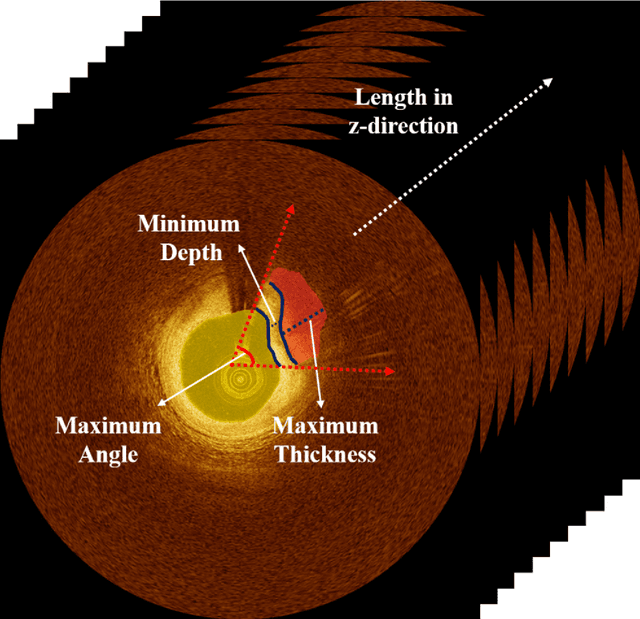 Figure 1 for OCTOPUS -- optical coherence tomography plaque and stent analysis software
