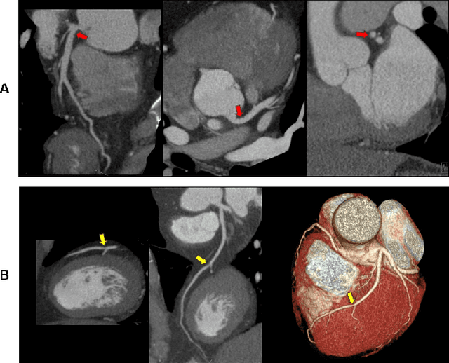 Figure 4 for Artificial Intelligence to Assist in Exclusion of Coronary Atherosclerosis during CCTA Evaluation of Chest-Pain in the Emergency Department: Preparing an Application for Real-World Use