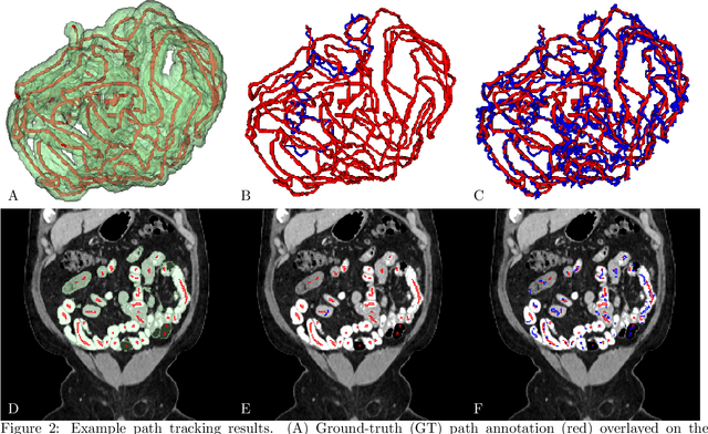 Figure 3 for A Graph-theoretic Algorithm for Small Bowel Path Tracking in CT Scans