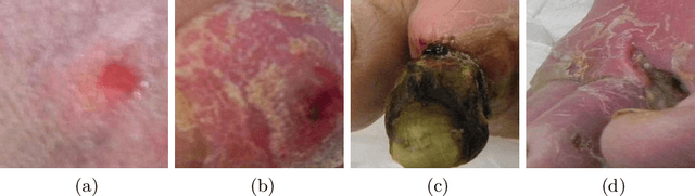 Figure 1 for Convolutional Nets Versus Vision Transformers for Diabetic Foot Ulcer Classification