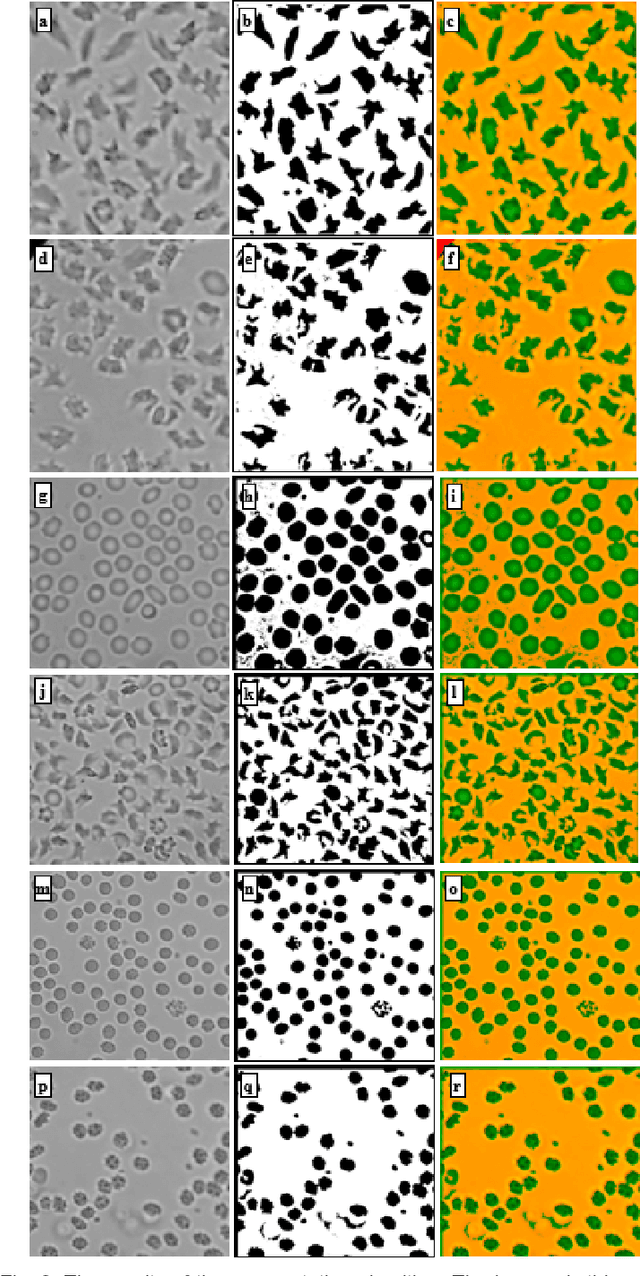 Figure 3 for Single Test Image-Based Automated Machine Learning System for Distinguishing between Trait and Diseased Blood Samples