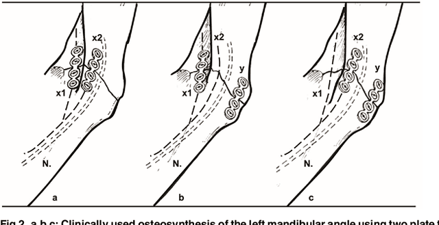 Figure 3 for Computer-aided position planning of miniplates to treat facial bone defects