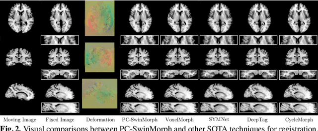 Figure 3 for PC-SwinMorph: Patch Representation for Unsupervised Medical Image Registration and Segmentation