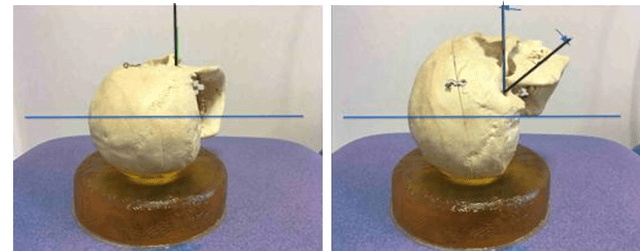 Figure 4 for Geometric Atlas of the Middle Ear and Paranasal Sinuses for Robotic Applications