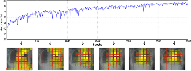 Figure 3 for Learning what to look in chest X-rays with a recurrent visual attention model
