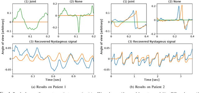 Figure 3 for Extraction of Nystagmus Patterns from Eye-Tracker Data with Convolutional Sparse Coding