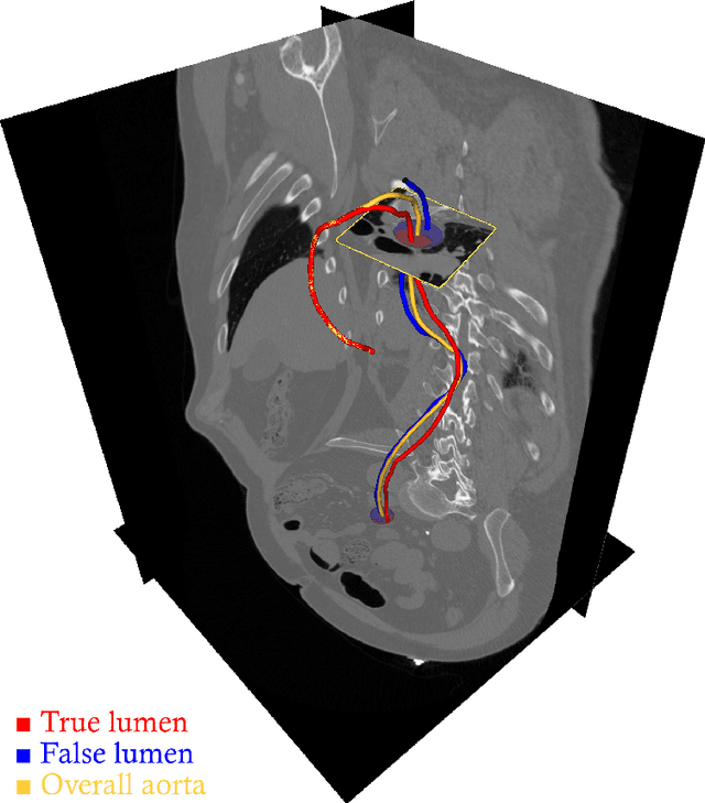 Figure 3 for Automated cross-sectional view selection in CT angiography of aortic dissections with uncertainty awareness and retrospective clinical annotations