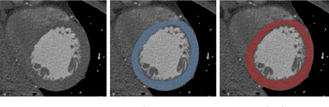 Figure 1 for Automatic Segmentation of the Left Ventricle in Cardiac CT Angiography Using Convolutional Neural Network