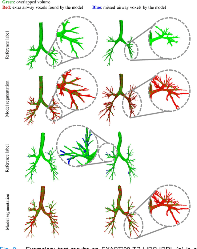 Figure 3 for NaviAirway: a bronchiole-sensitive deep learning-based airway segmentation pipeline for planning of navigation bronchoscopy