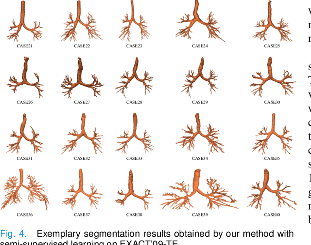 Figure 4 for NaviAirway: a bronchiole-sensitive deep learning-based airway segmentation pipeline for planning of navigation bronchoscopy