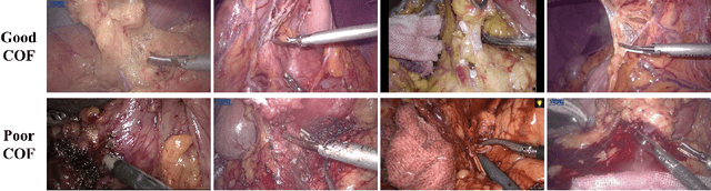 Figure 2 for Surgical Skill Assessment on In-Vivo Clinical Data via the Clearness of Operating Field
