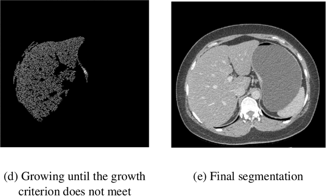 Figure 2 for Applying a random projection algorithm to optimize machine learning model for predicting peritoneal metastasis in gastric cancer patients using CT images