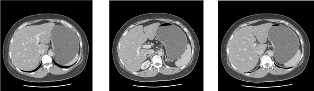 Figure 3 for Applying a random projection algorithm to optimize machine learning model for predicting peritoneal metastasis in gastric cancer patients using CT images