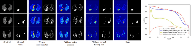 Figure 4 for Towards Unbiased COVID-19 Lesion Localisation and Segmentation via Weakly Supervised Learning