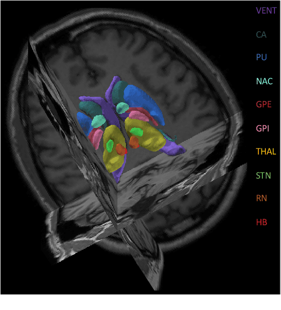 Figure 1 for DBSegment: Fast and robust segmentation of deep brain structures -- Evaluation of transportability across acquisition domains