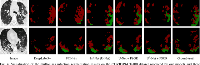 Figure 4 for PSGR: Pixel-wise Sparse Graph Reasoning for COVID-19 Pneumonia Segmentation in CT Images