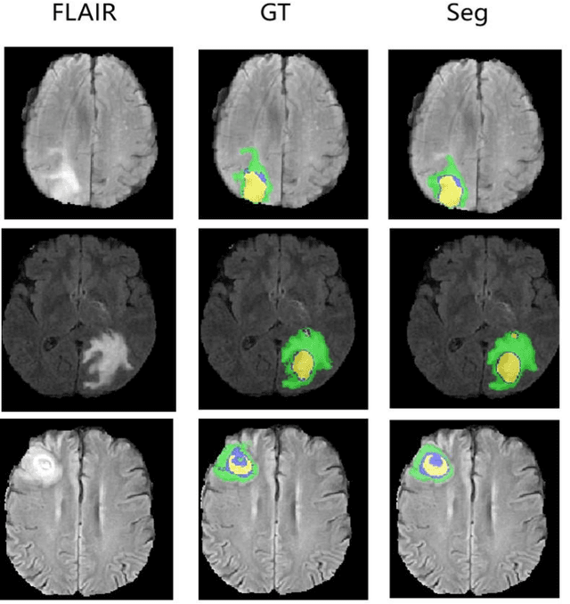 Figure 3 for A Transformer-based Generative Adversarial Network for Brain Tumor Segmentation