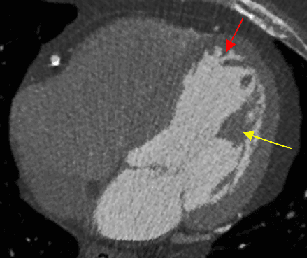 Figure 1 for Morphological Analusis Of The Left Ventricular Eendocardial Surface Using A Bag-Of-Features Descriptor