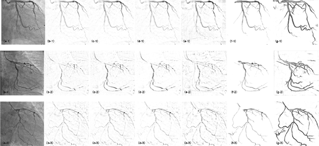 Figure 2 for Robust PCA Unrolling Network for Super-resolution Vessel Extraction in X-ray Coronary Angiography