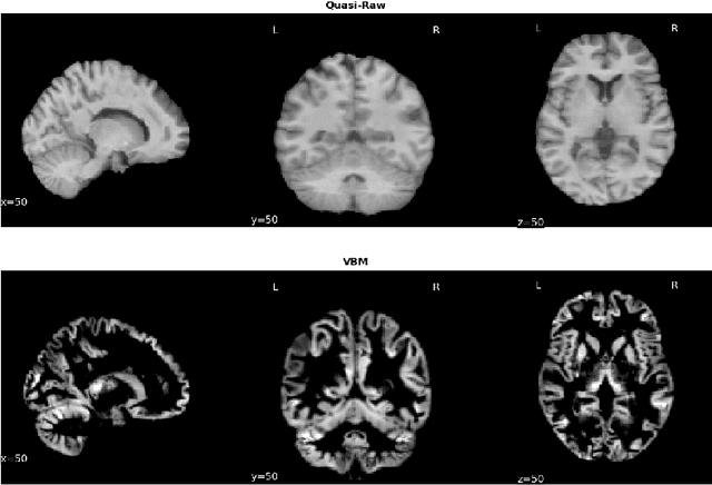 Figure 2 for Benchmarking CNN on 3D Anatomical Brain MRI: Architectures, Data Augmentation and Deep Ensemble Learning