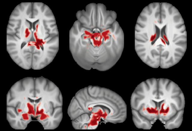 Figure 2 for Voxel-level Importance Maps for Interpretable Brain Age Estimation