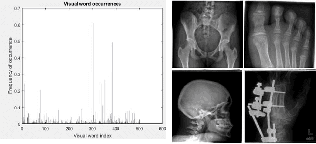 Figure 1 for A Bag of Visual Words Model for Medical Image Retrieval