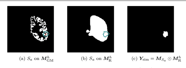 Figure 1 for A self-supervised learning strategy for postoperative brain cavity segmentation simulating resections