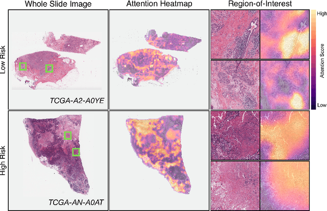 Figure 3 for Whole Slide Images are 2D Point Clouds: Context-Aware Survival Prediction using Patch-based Graph Convolutional Networks