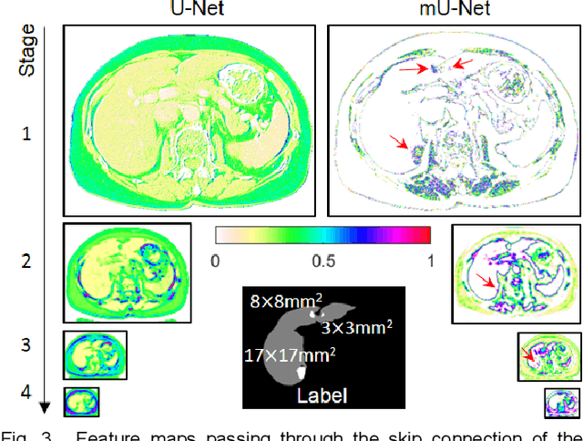 Figure 4 for Modified U-Net with Incorporation of Object-Dependent High Level Features for Improved Liver and Liver-Tumor Segmentation in CT Images
