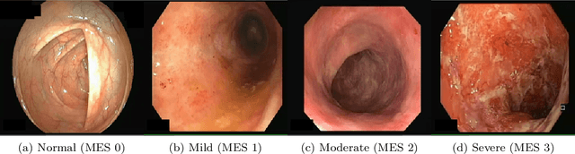 Figure 1 for Automatic Estimation of Ulcerative Colitis Severity from Endoscopy Videos using Ordinal Multi-Instance Learning