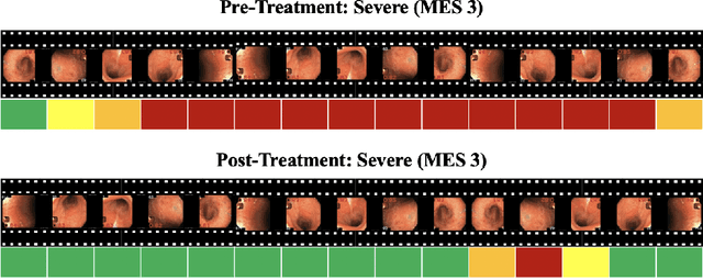 Figure 2 for Automatic Estimation of Ulcerative Colitis Severity from Endoscopy Videos using Ordinal Multi-Instance Learning