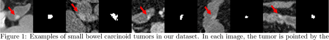 Figure 1 for Improving Small Lesion Segmentation in CT Scans using Intensity Distribution Supervision: Application to Small Bowel Carcinoid Tumor