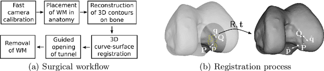 Figure 3 for Video-based computer aided arthroscopy for patient specific reconstruction of the Anterior Cruciate Ligament