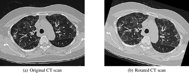 Figure 3 for Comparative performance analysis of the ResNet backbones of Mask RCNN to segment the signs of COVID-19 in chest CT scans